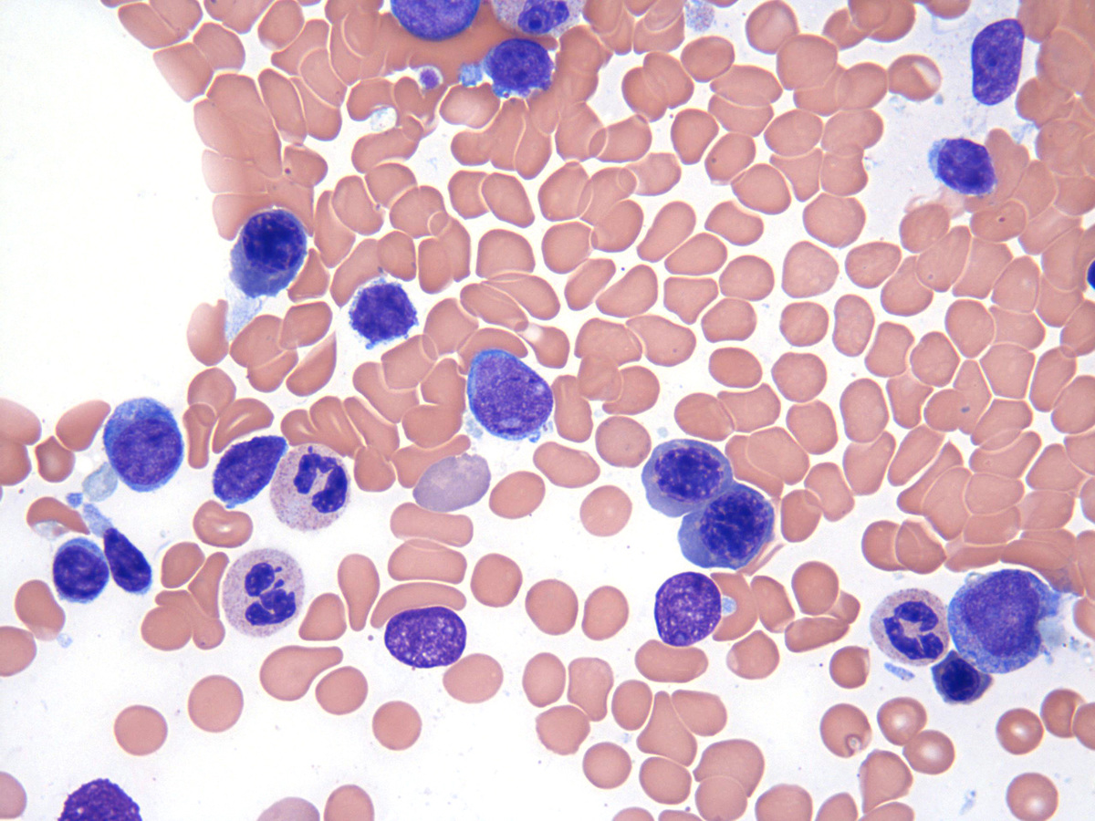 Bone Marrow aspirate_6